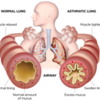 normal-vs-asthma-lung