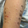 intradermal-allergy-testing