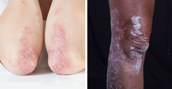 psoriasis on different skin tones