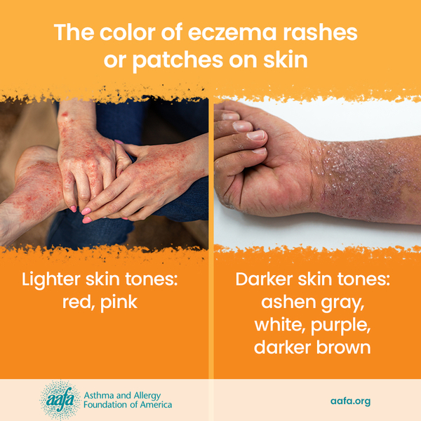 Two images that show the differences of eczema on different skin tones